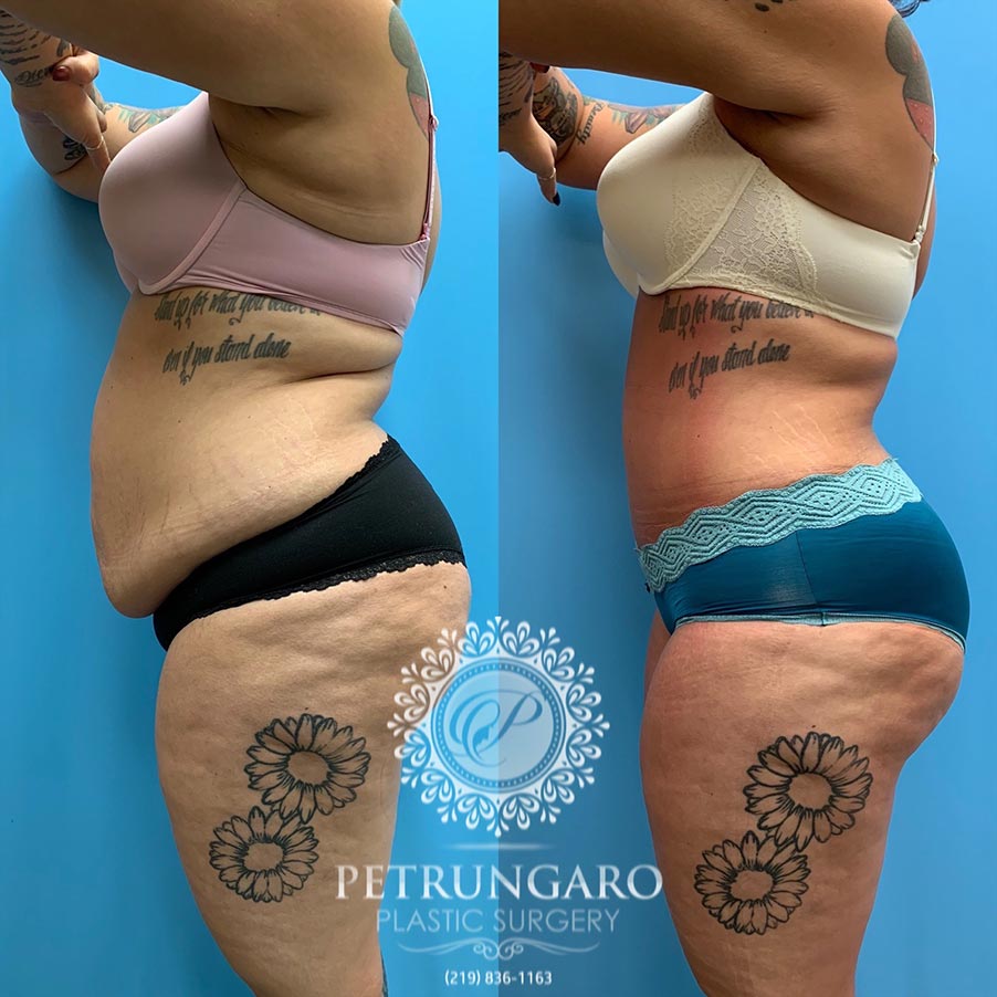 28 year old woman 3 months after Tummy Tuck with Lipo 360-2