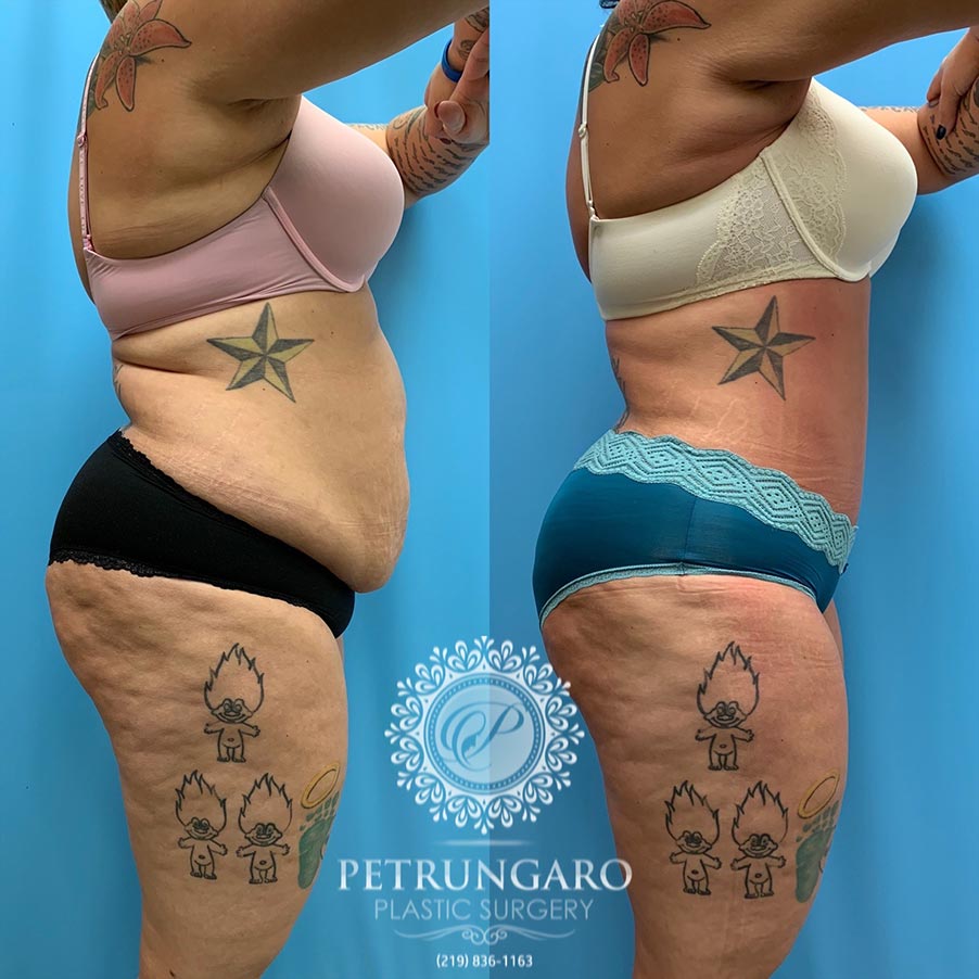 28 year old woman 3 months after Tummy Tuck with Lipo 360-3