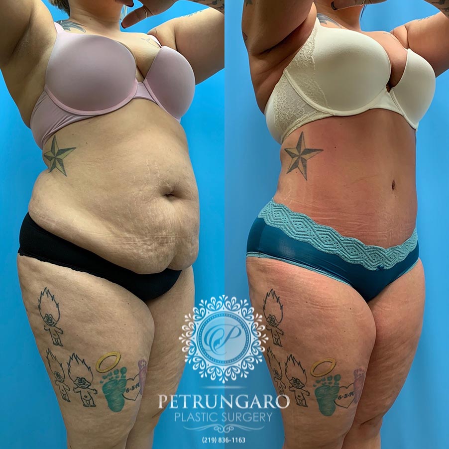 28 year old woman 3 months after Tummy Tuck with Lipo 360-4