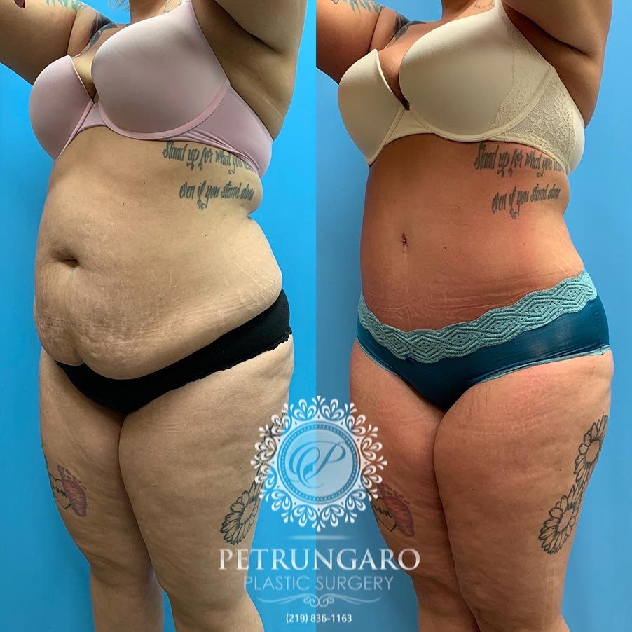 28 year old woman 3 months after Tummy Tuck with Lipo 360-5