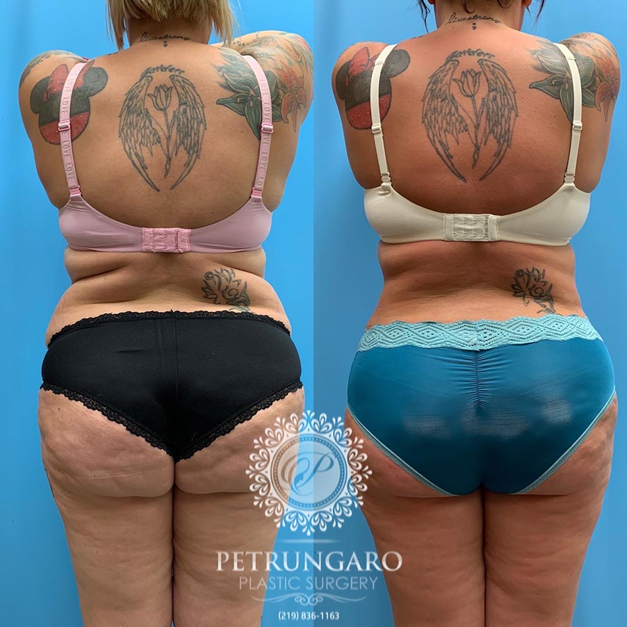 28 year old woman 3 months after Tummy Tuck with Lipo 360-6