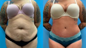 28 year old woman 3 months after Tummy Tuck with Lipo 360-f