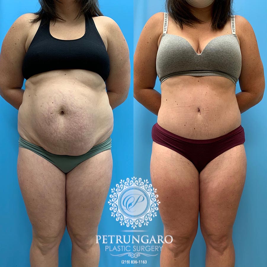 31 year old woman 5 months after Tummy Tuck with Lipo 360-1