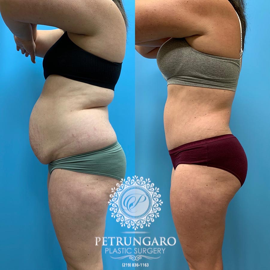 31 year old woman 5 months after Tummy Tuck with Lipo 360-2