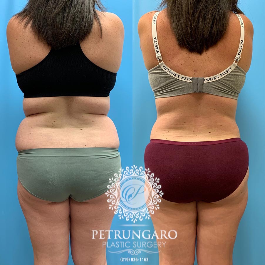 31 year old woman 5 months after Tummy Tuck with Lipo 360-6