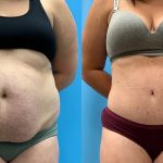 31 year old woman 5 months after Tummy Tuck with Lipo 360-f