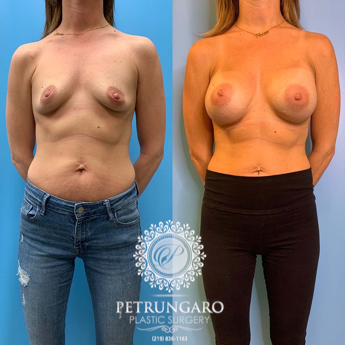 37 year old woman 3 months after breast augmentation-1