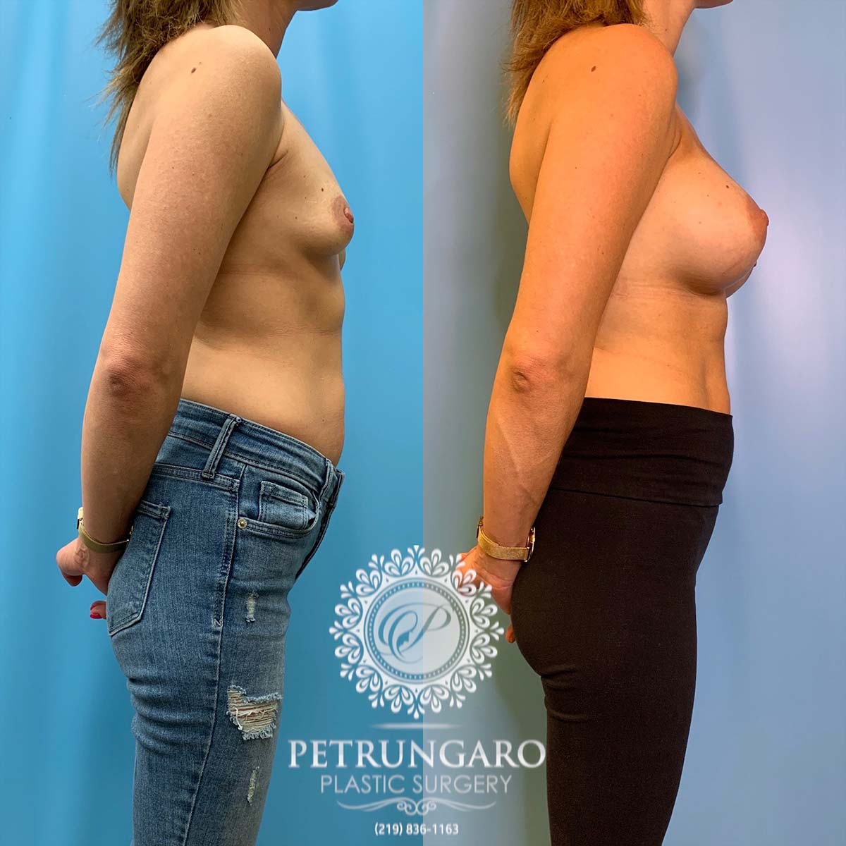 37 year old woman 3 months after breast augmentation-3