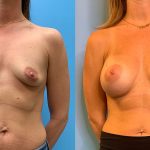 37 year old woman 3 months after breast augmentation-f
