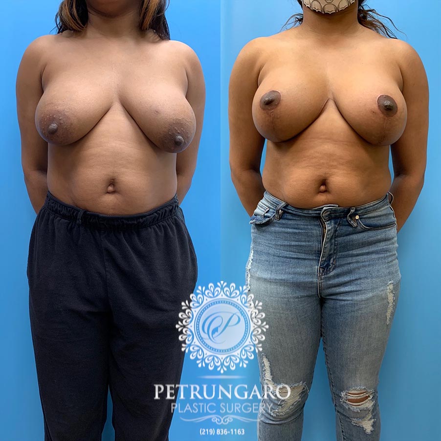 39 year old woman 3 months after Anchor-Pattern Breast Lift with Implants-1