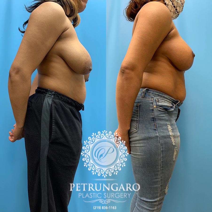 39 year old woman 3 months after Anchor-Pattern Breast Lift with Implants-3