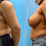39 year old woman 3 months after Anchor-Pattern Breast Lift with Implants-f