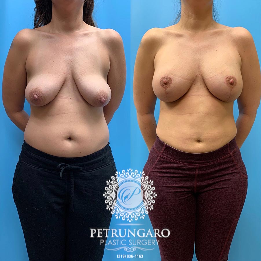 42 year old woman 3 months after Breast Lift with Implants-1