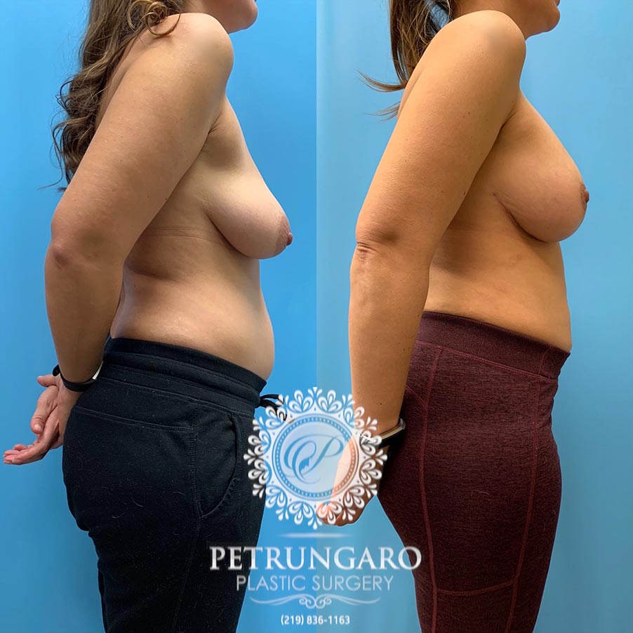42 year old woman 3 months after Breast Lift with Implants-3