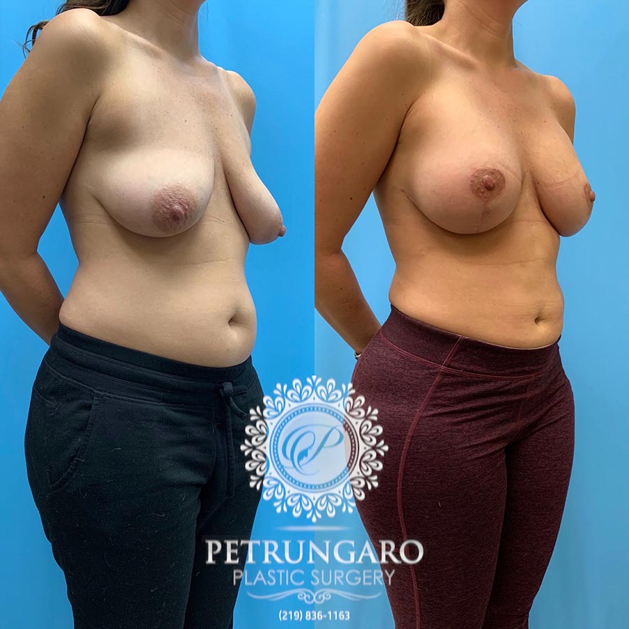 42 year old woman 3 months after Breast Lift with Implants-4