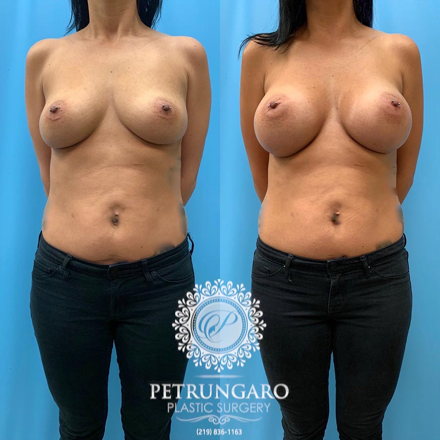 43 year old woman 3 months after Breast Augmentation-2