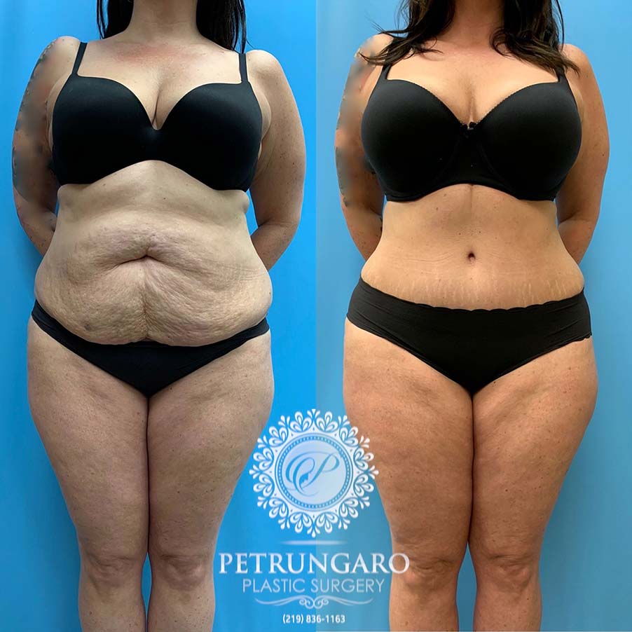 47 year old woman 4 months after Tummy Tuck with Lipo 360-1