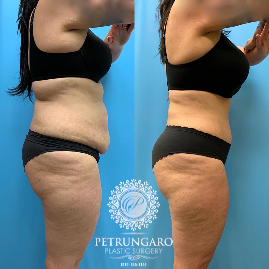 47 year old woman 4 months after Tummy Tuck with Lipo 360-3