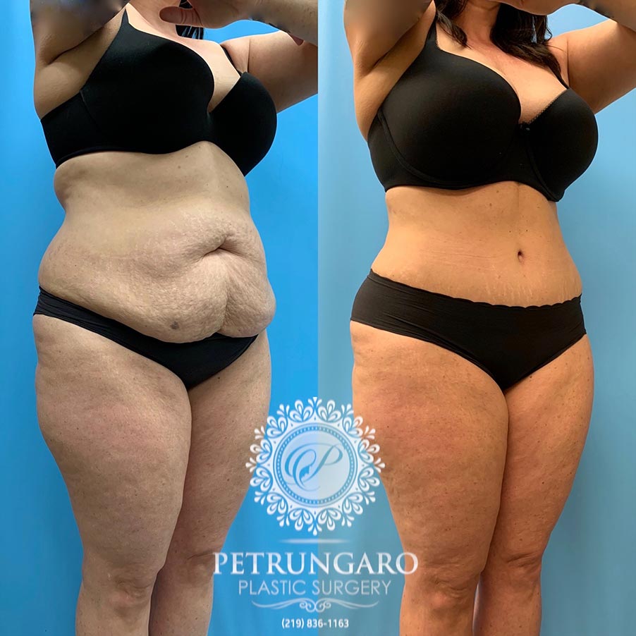47 year old woman 4 months after Tummy Tuck with Lipo 360-4