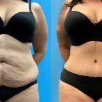 47 year old woman 4 months after Tummy Tuck with Lipo 360-f
