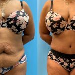 48 year old woman 4 months after Tummy Tuck with Lipo 360-f