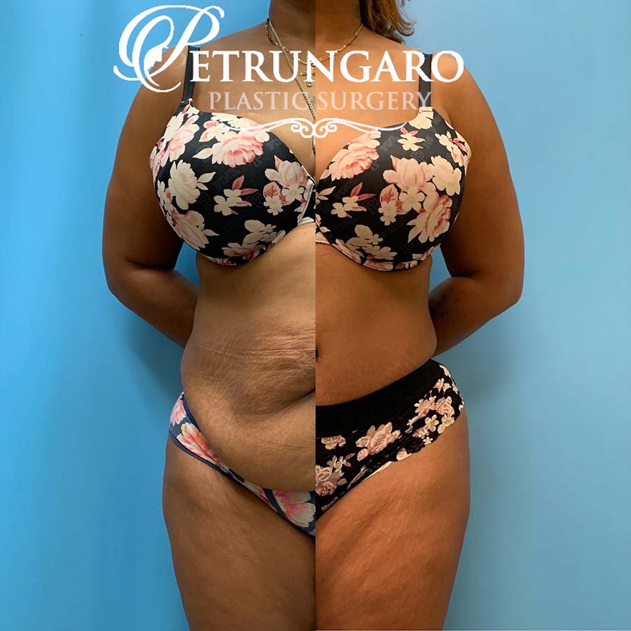 48 year old woman 4 months after Tummy Tuck with Lipo 360-2