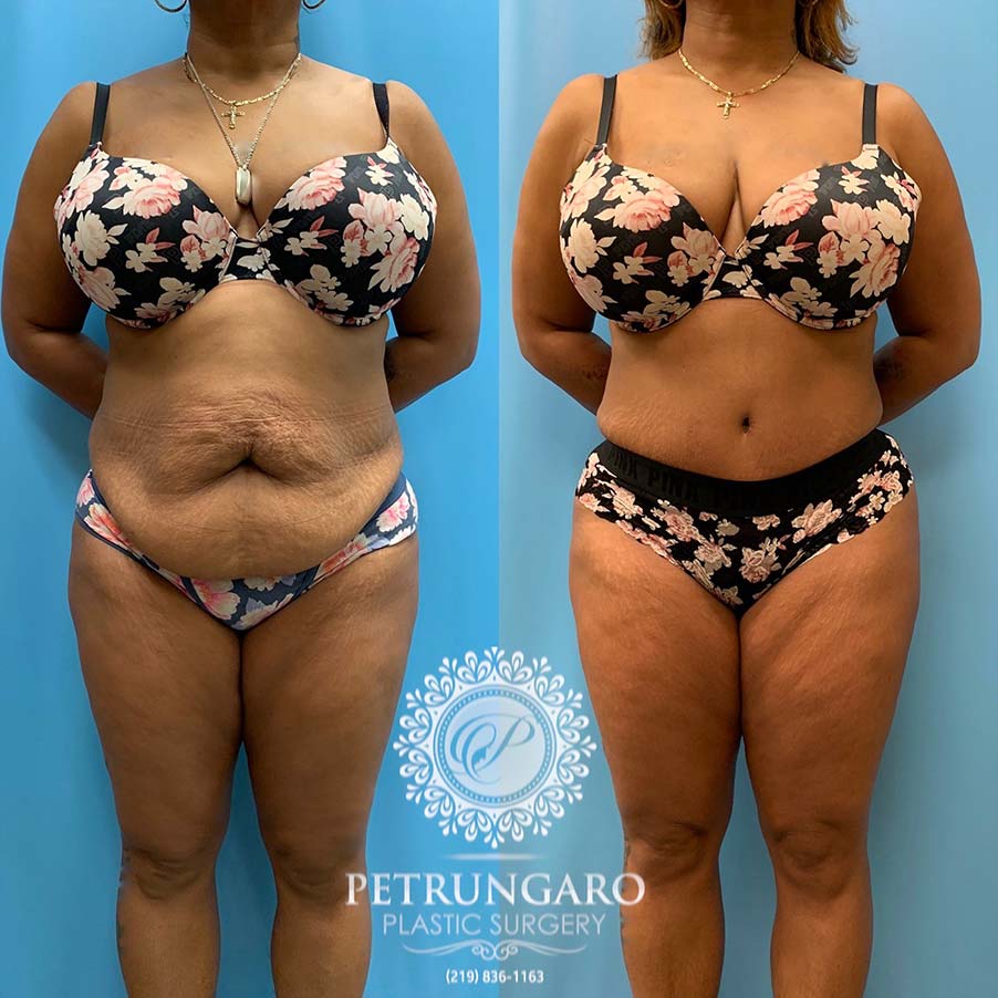 48 year old woman 4 months after Tummy Tuck with Lipo 360-3