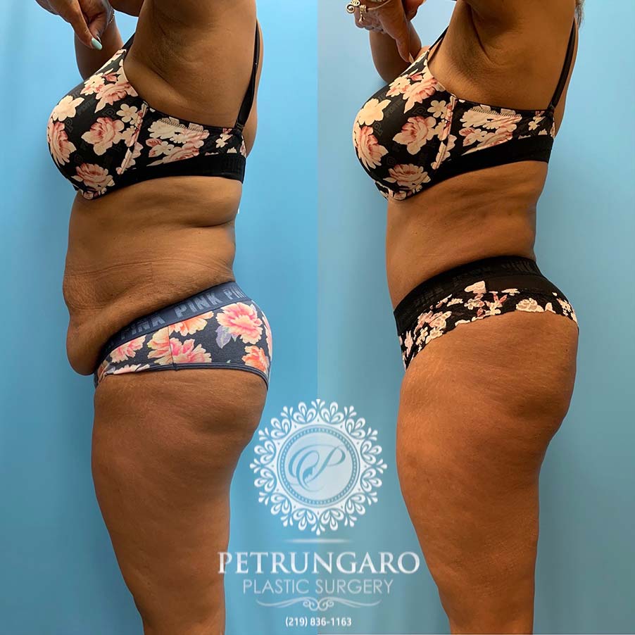 48 year old woman 4 months after Tummy Tuck with Lipo 360-4