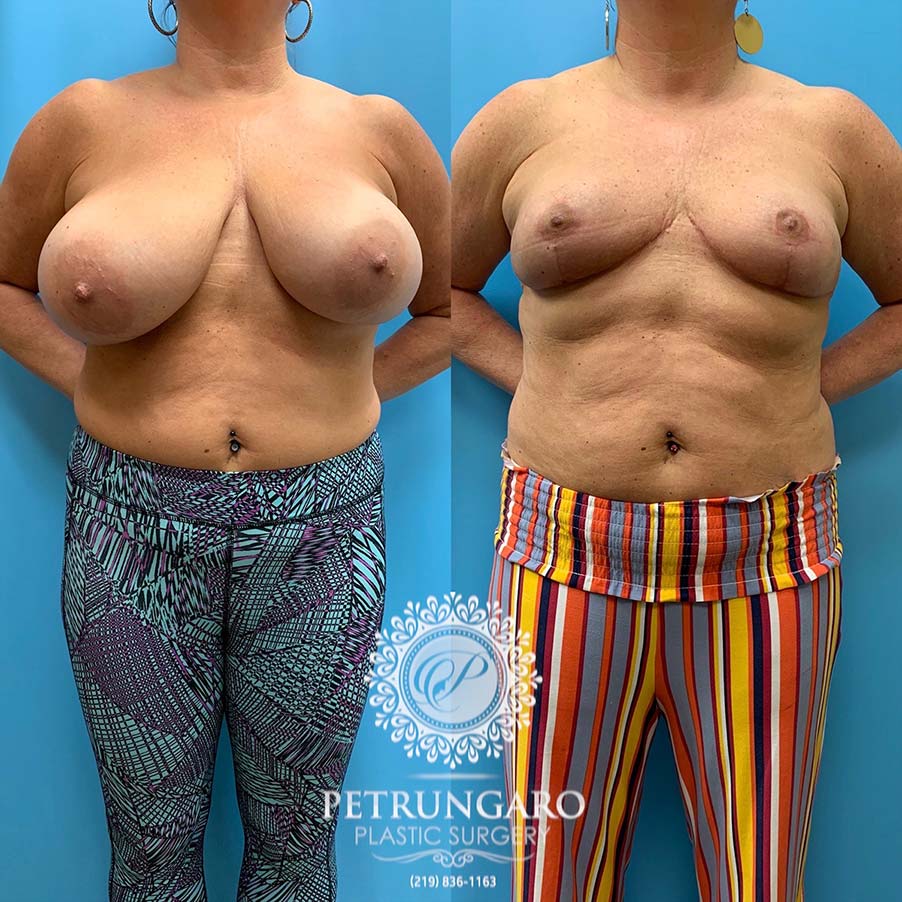 50 year old woman 3 months after Breast Reduction-1