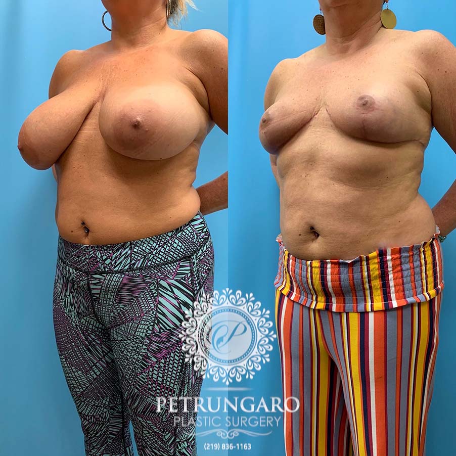 50 year old woman 3 months after Breast Reduction -5