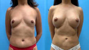 51 year old woman 5 months after Breast Augmentation with Lipo 360-f