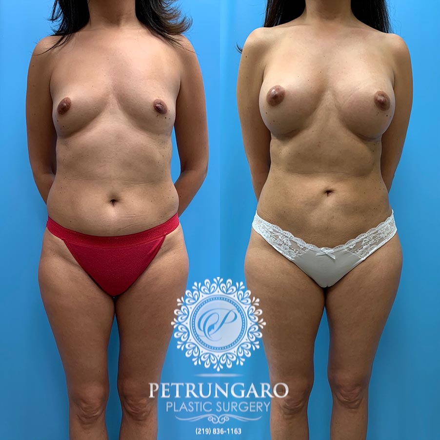 51 year old woman 5 months after Breast Augmentation with Lipo 360-2