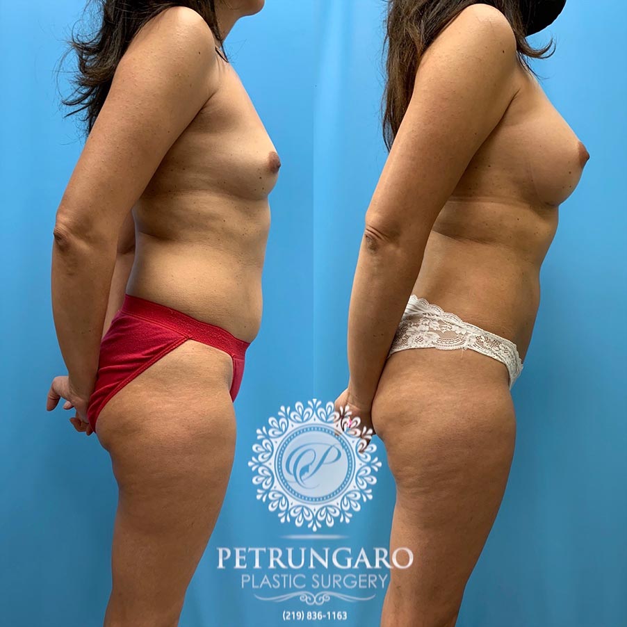 51 year old woman 5 months after Breast Augmentation with Lipo 360-4