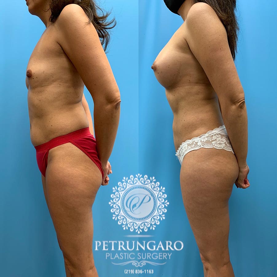 51 year old woman 5 months after Breast Augmentation with Lipo 3600-3