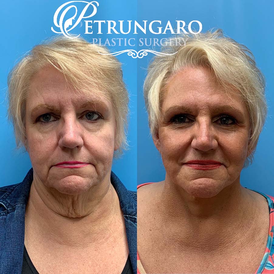 67 year old woman 8 months after facelift and necklift-1