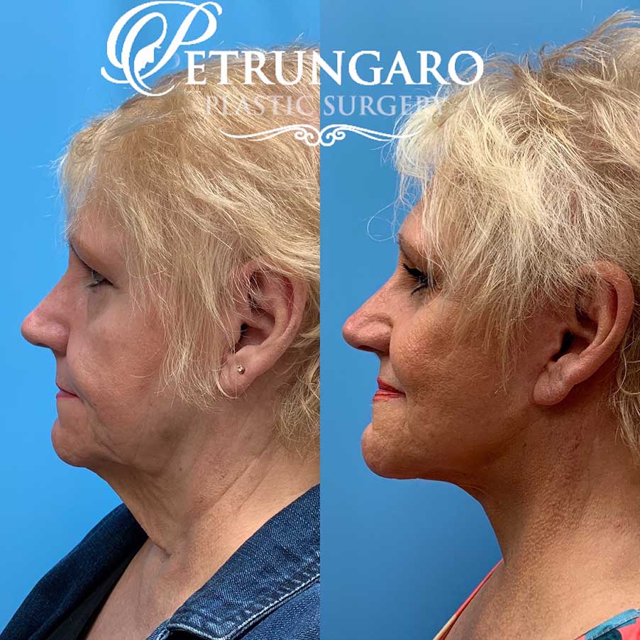 67 year old woman 8 months after facelift and necklift-2