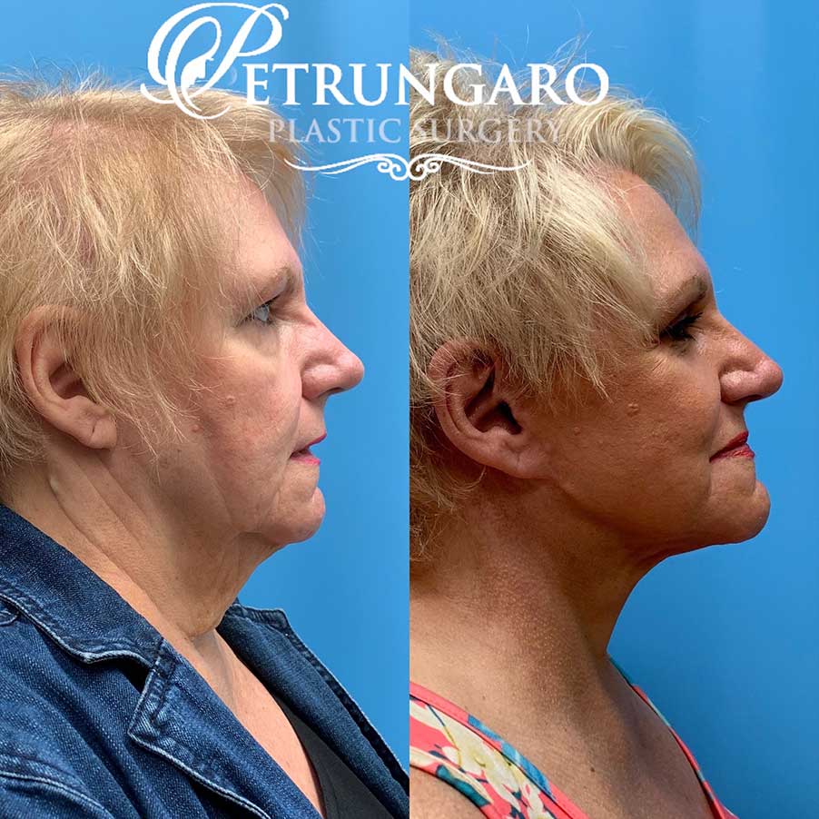 67 year old woman 8 months after facelift and necklift-3
