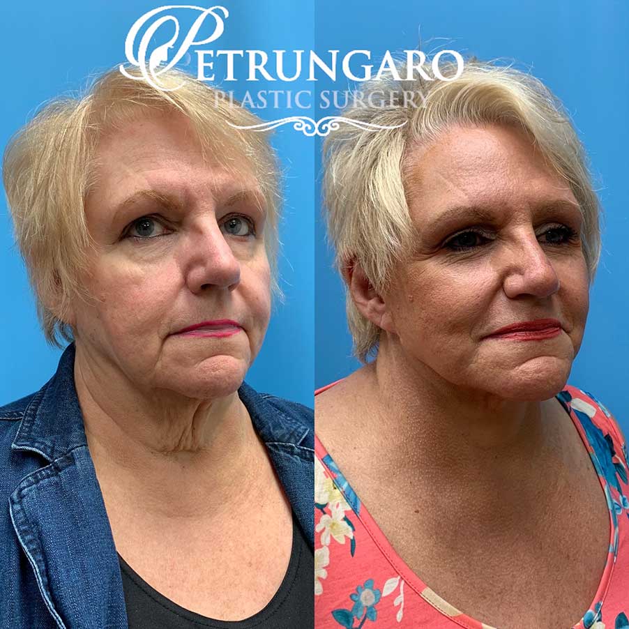 67 year old woman 8 months after facelift and necklift-4
