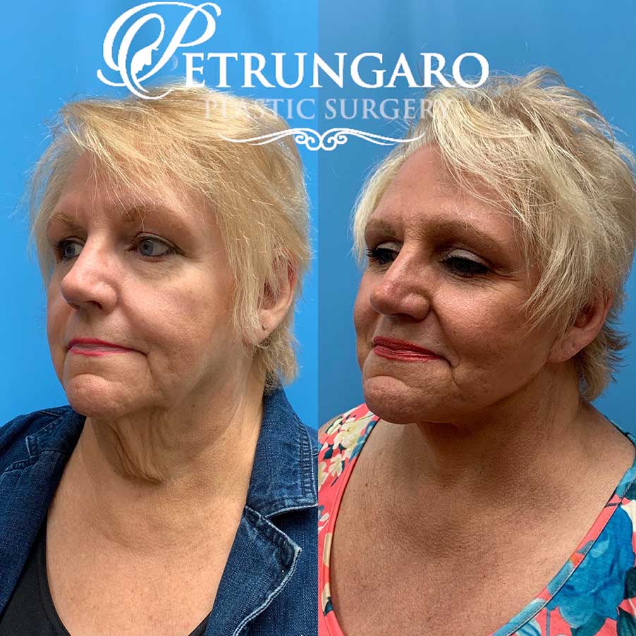 67 year old woman 8 months after facelift and necklift-5