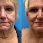 67 year old woman 8 months after facelift and necklift-f