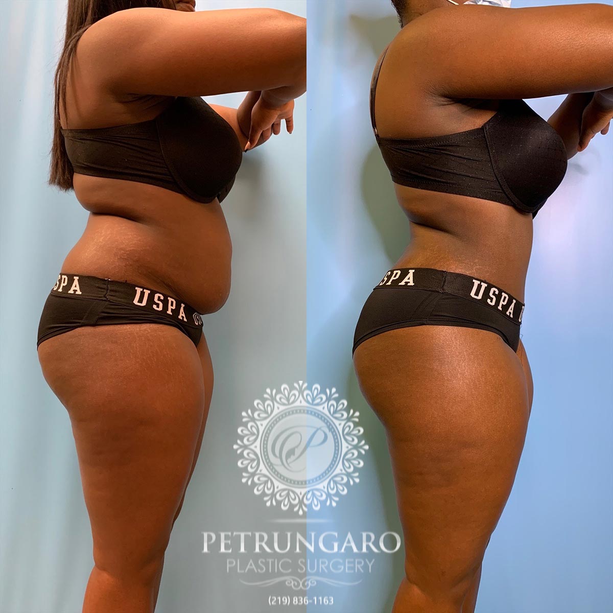30 year old woman 3 months after tummy tuck with Lipo 360-3
