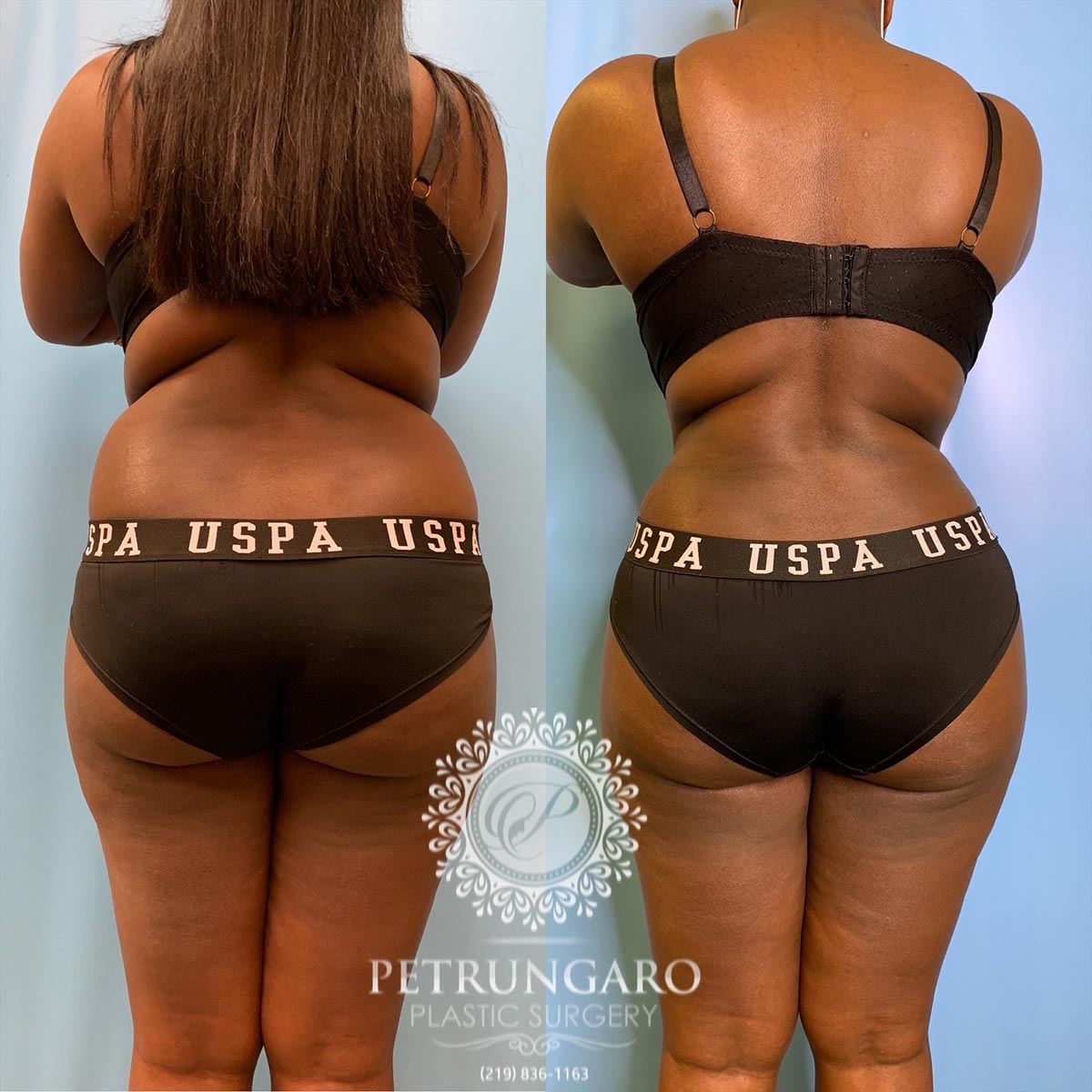 30 year old woman 3 months after tummy tuck with Lipo 360-6