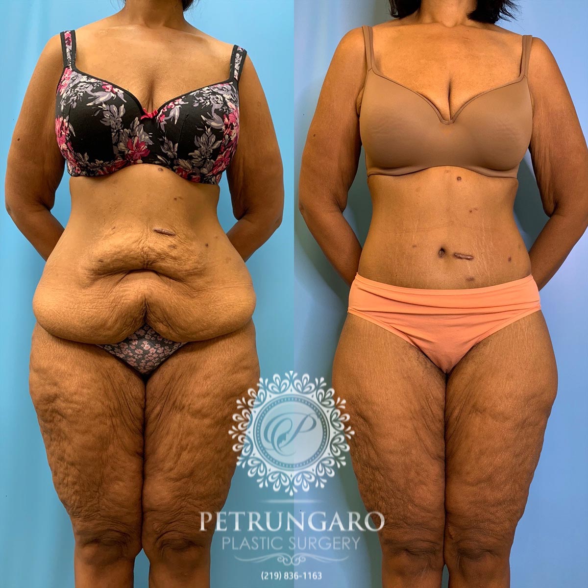 42 year old woman 3 months after a circumferential body lift-1