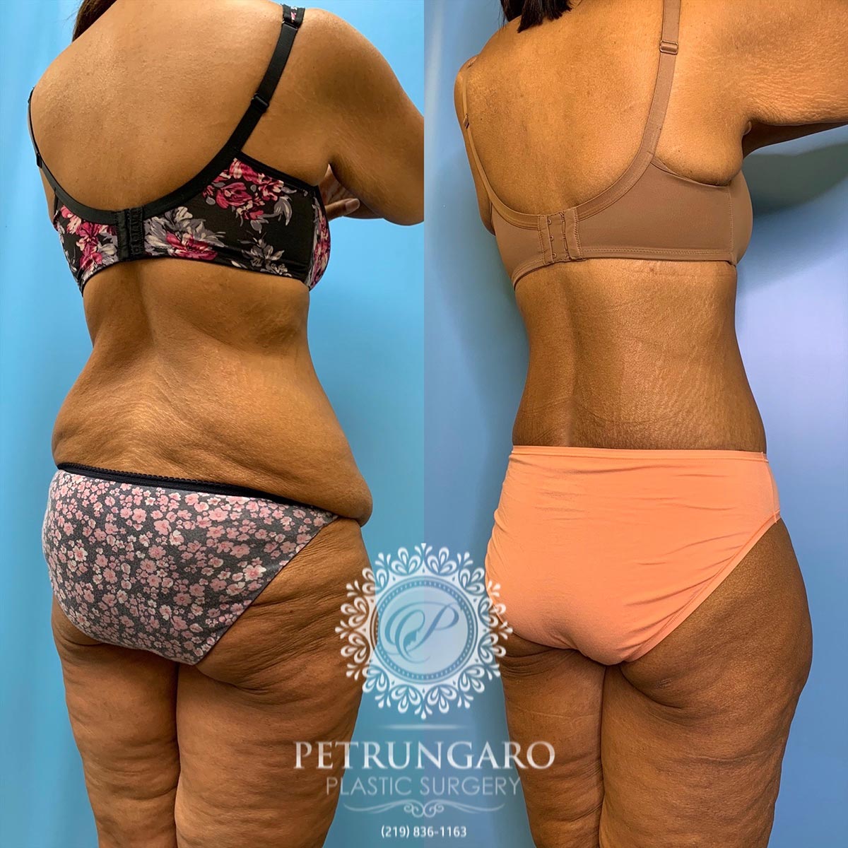 42 year old woman 3 months after a circumferential body lift-10