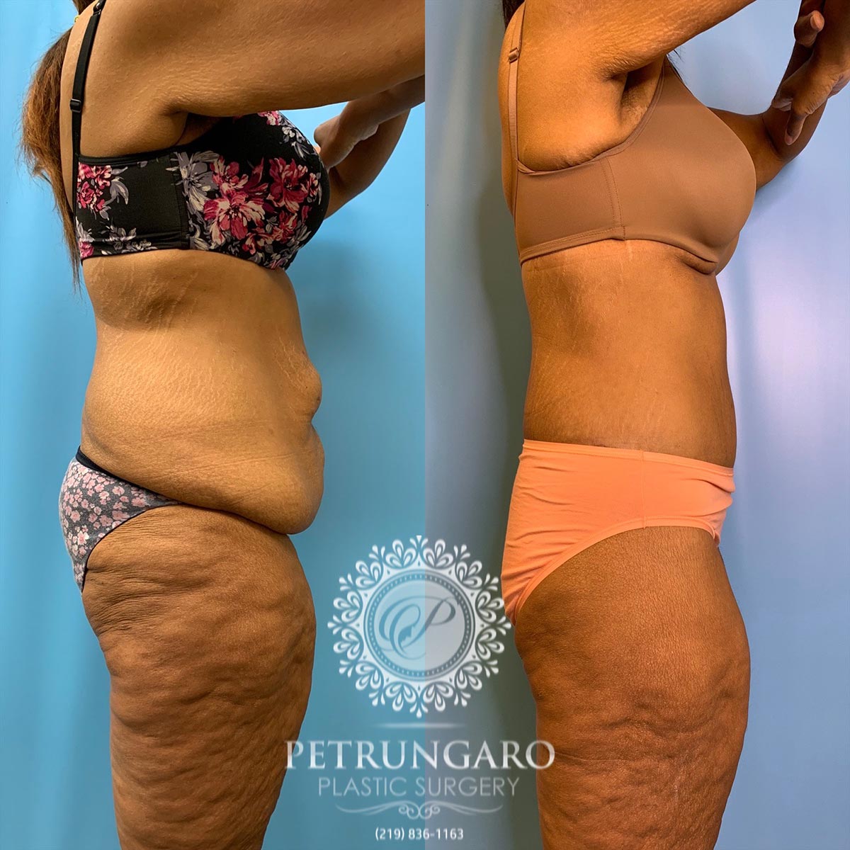 42 year old woman 3 months after a circumferential body lift-3
