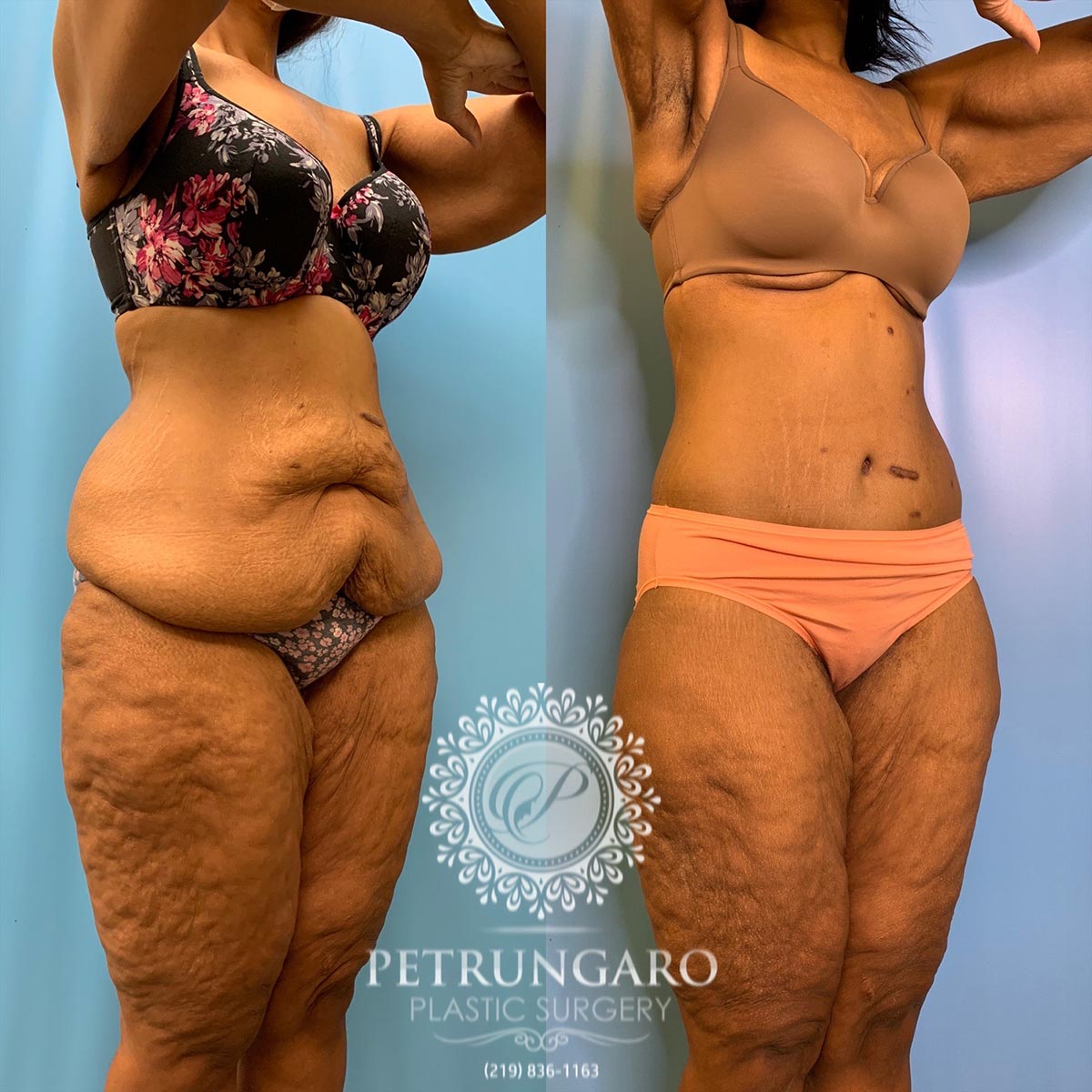 42 year old woman 3 months after a circumferential body lift-4