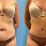 49 year old woman three months after tummy tuck with Lipo 360-f