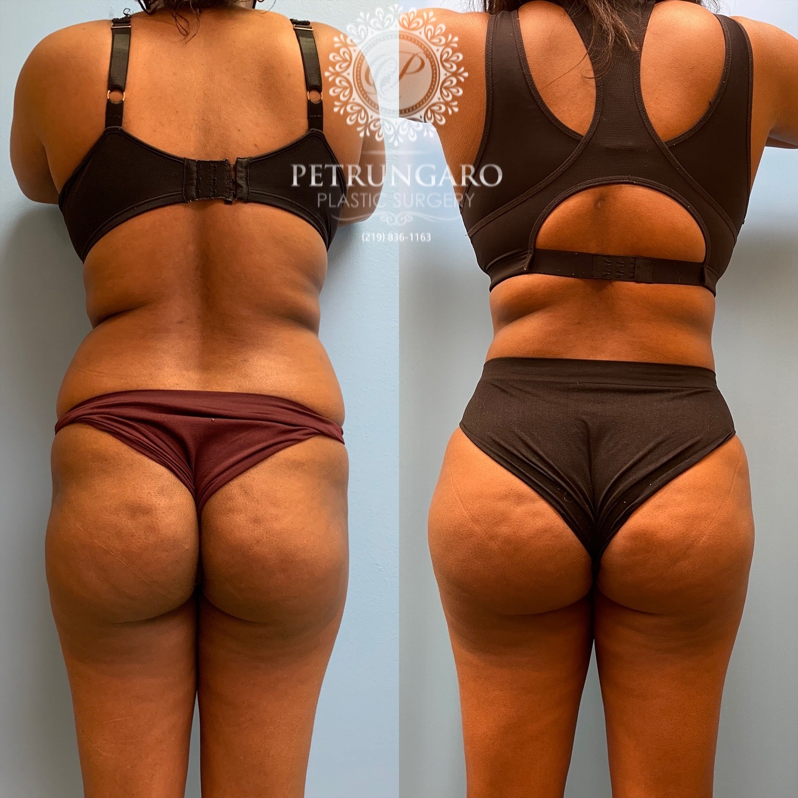 25 year old woman 3 months after Brazilian Butt Lift-6