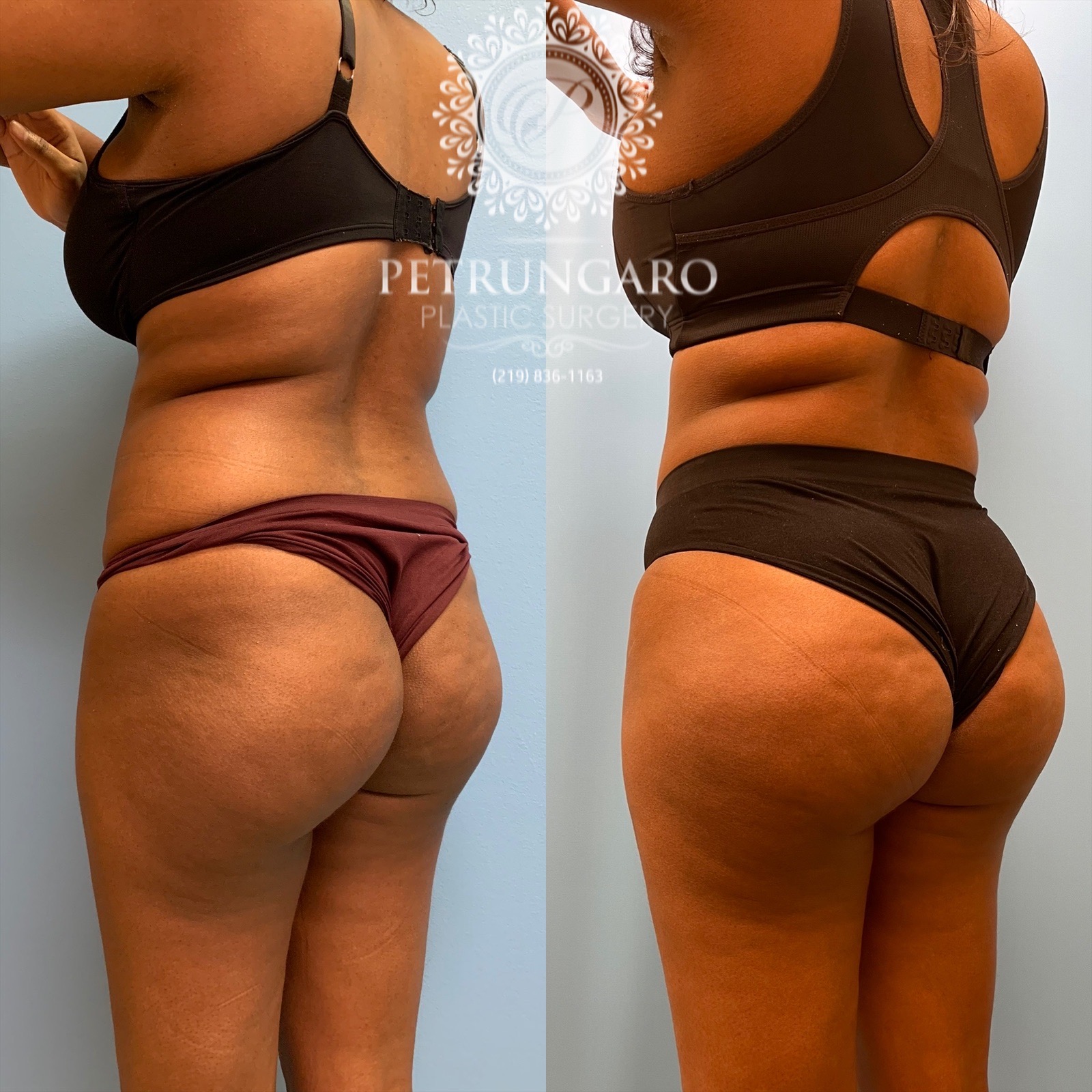 25 year old woman 3 months after Brazilian Butt Lift-8