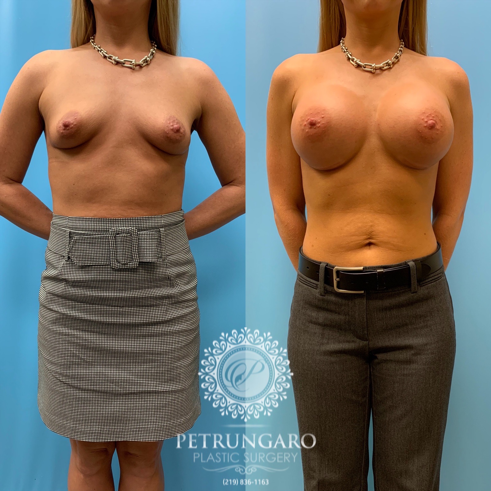 31 year old woman 3 months after breast augmentation-1